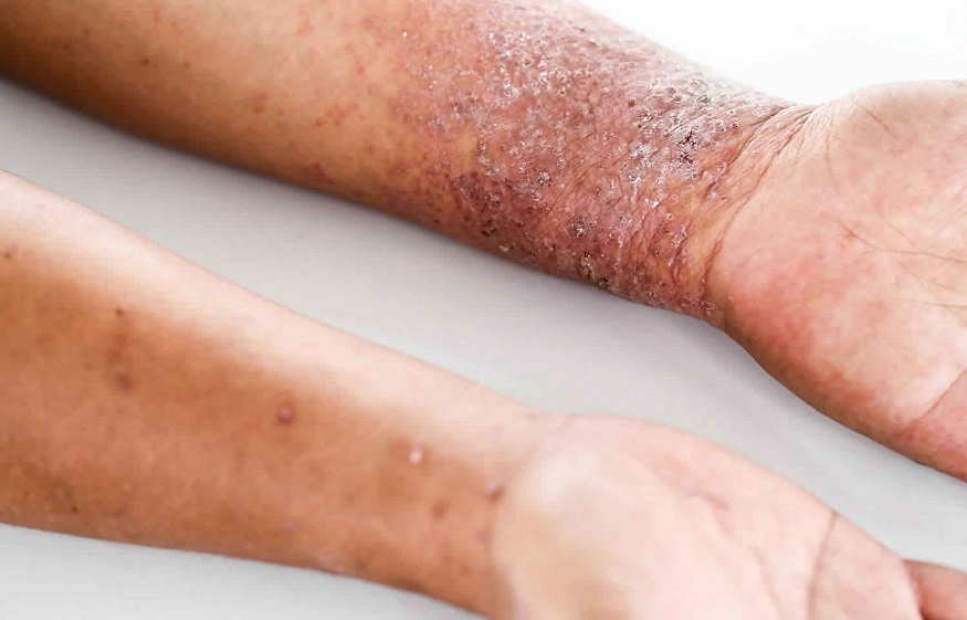 Treatments Of Atopic dermatitis The diagnosis
