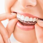 What Are The Benefits Of Invisalign Aligners?