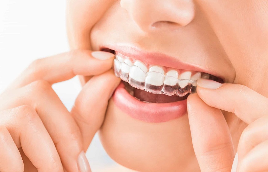 Invisalign Aligners