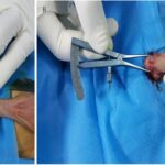 Hypospadias Surgery