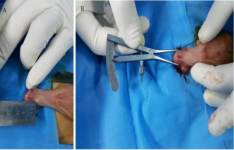 Hypospadias Surgery